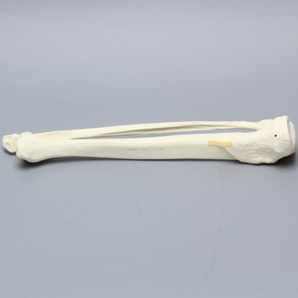 Tibia and Fibula with Type Six Tibial Plateau Fracture