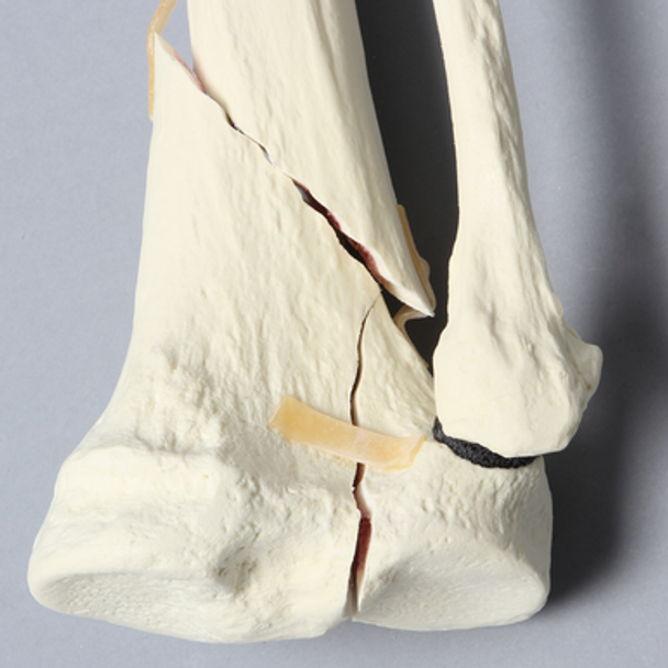 Tibia and Fibula with Type Six Tibial Plateau Fracture