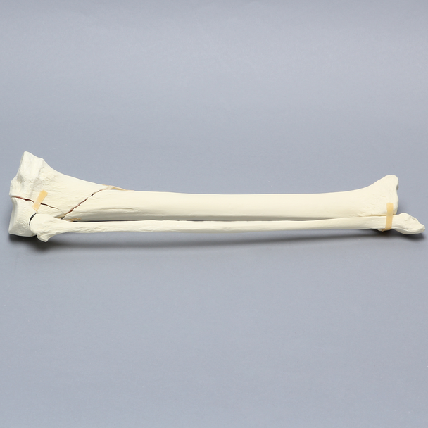 Tibia and Fibula with Type Six Tibial Plateau Fracture