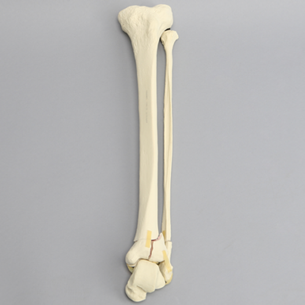 Tibia and Fibula with Pilon and Fractures
