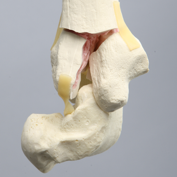 Tibia and Fibula with Pilon and Fractures