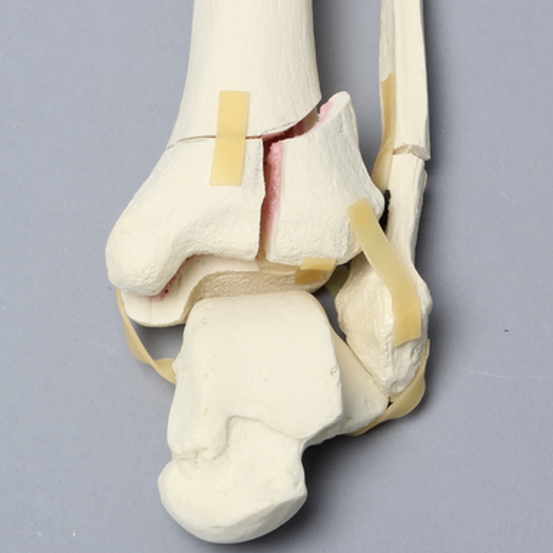 Tibia and Fibula with Pilon and Fractures