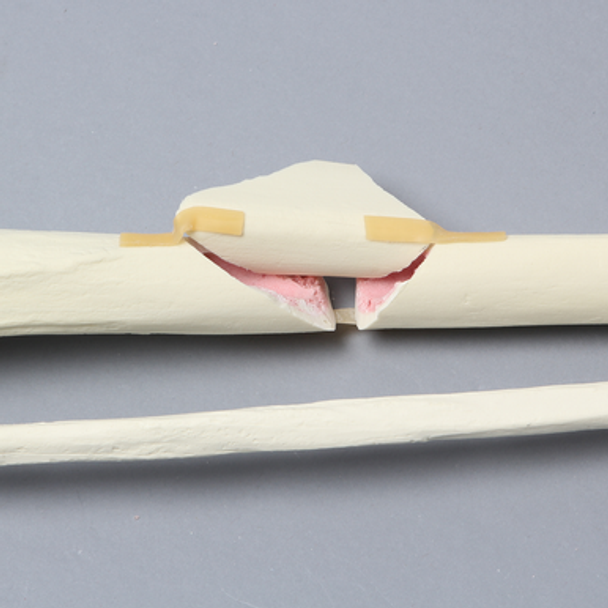 Tibia and Fibula with Butterfly Fracture