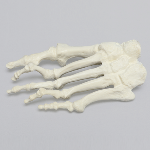 Forefoot with Hammertoes, Bunions, and Exostosis, Left