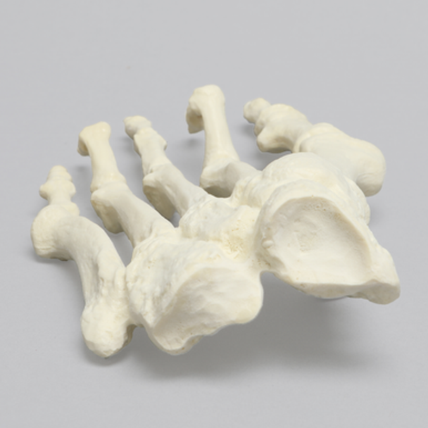 Forefoot with Hammertoes, Bunions, and Exostosis, Left