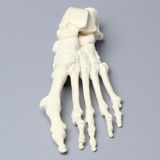Foot with Hammertoes, Bunions, and Heel Spur