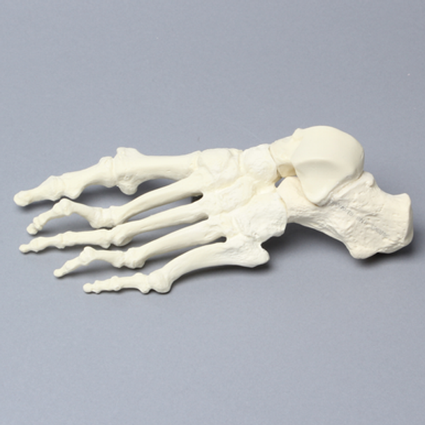 Foot with Hammertoes, Bunions, and Heel Spur