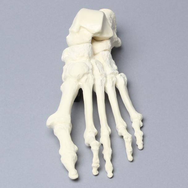 Foot with Hammertoes, Bunions, and Heel Spur