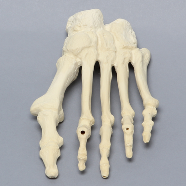 Forefoot with Hammertoes, Bunions, Exostosis, and Canals