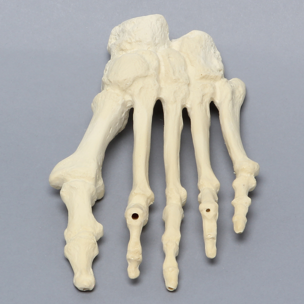 Forefoot with Hammertoes, Bunions, Exostosis, and Canals