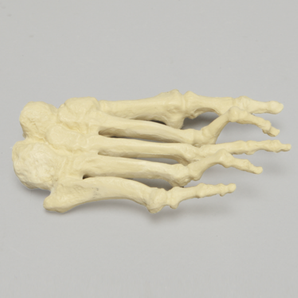 Forefoot with Hammertoes, Bunions, and Exostosis, Right