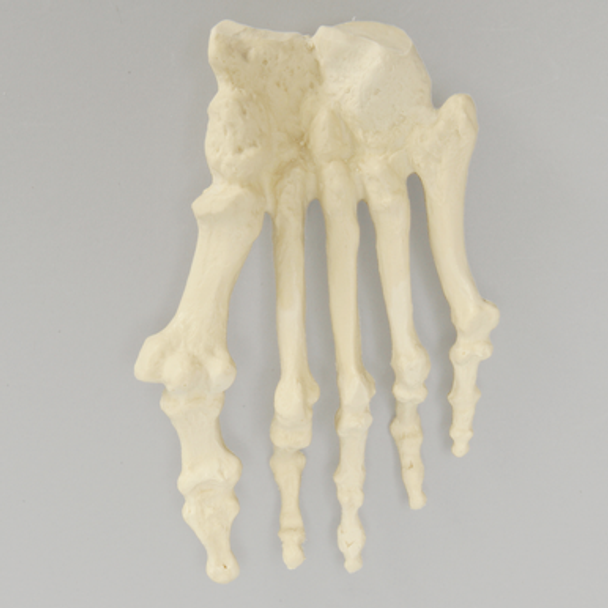 Forefoot with Hammertoes, Bunions, and Exostosis, Right
