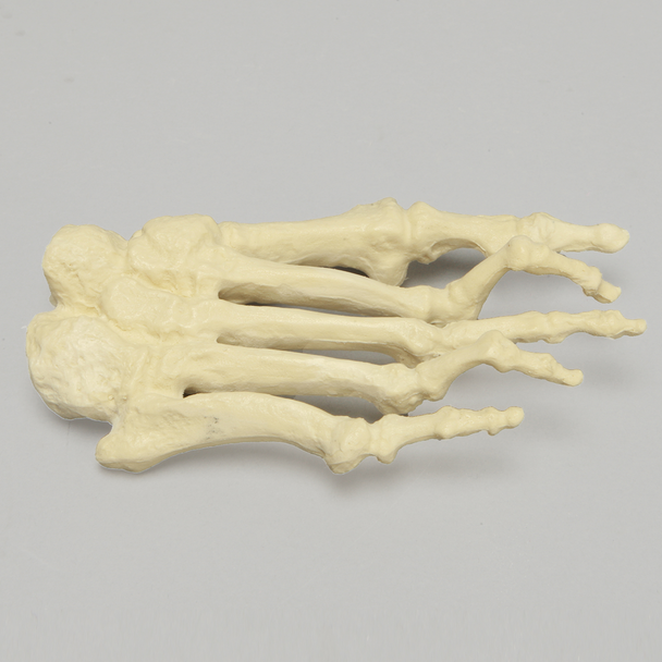 Forefoot with Hammertoes, Bunions, and Exostosis, Right