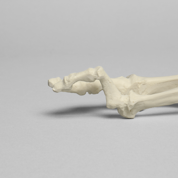 Metatarsals with Hammertoe and Bunion