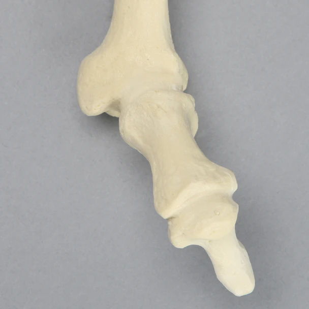 Metatarsal with Hammertoe