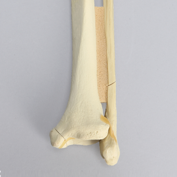 Ankle with Malleolar, Posterior, and Transverse Fractures