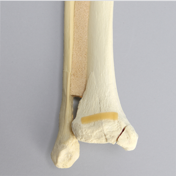 Ankle with Malleolar, Posterior, and Transverse Fractures