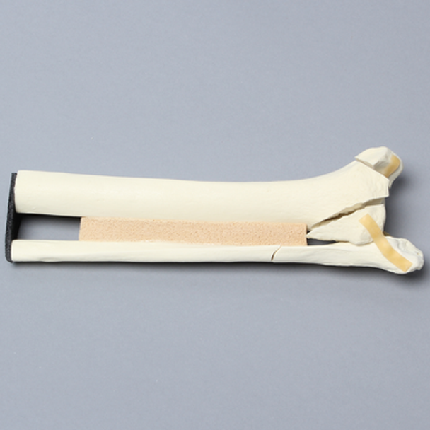 Ankle with Malleolar, Posterior, and Transverse Fractures