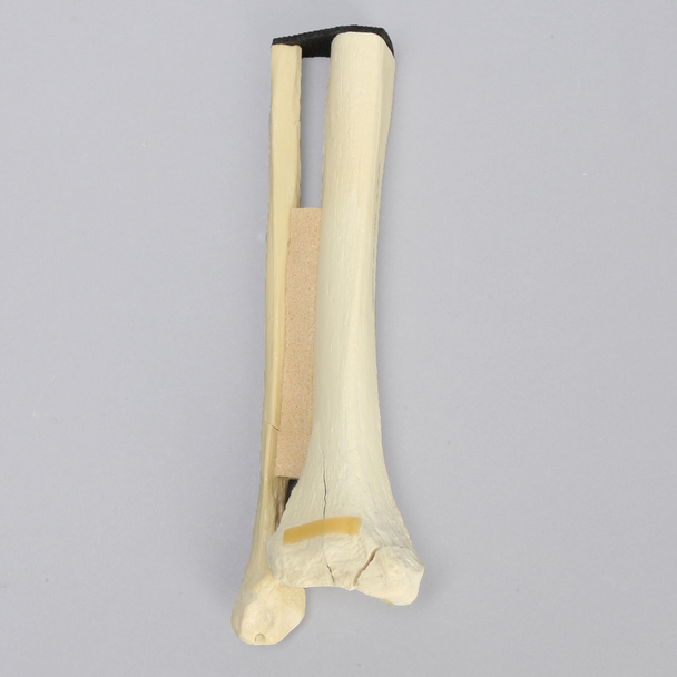 Ankle with Malleolar, Posterior, and Transverse Fractures