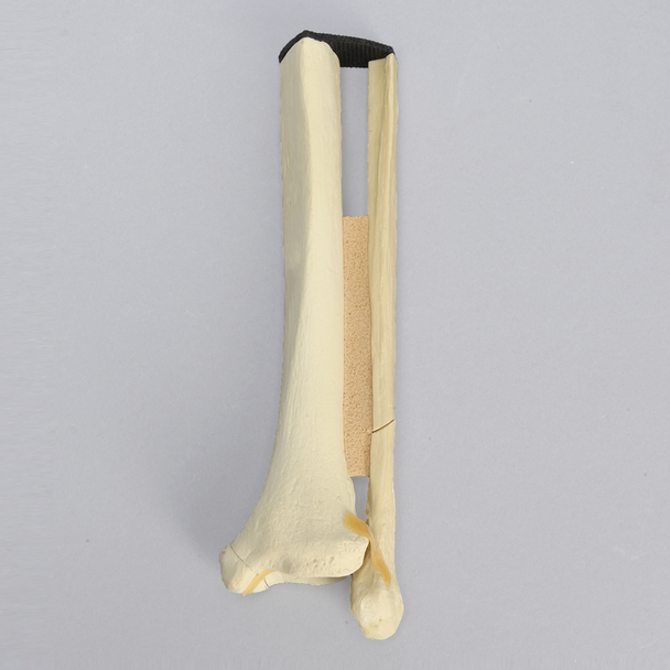 Ankle with Malleolar, Posterior, and Transverse Fractures