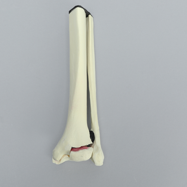 Ankle with Two-Part Triplane Fracture, Pediatric