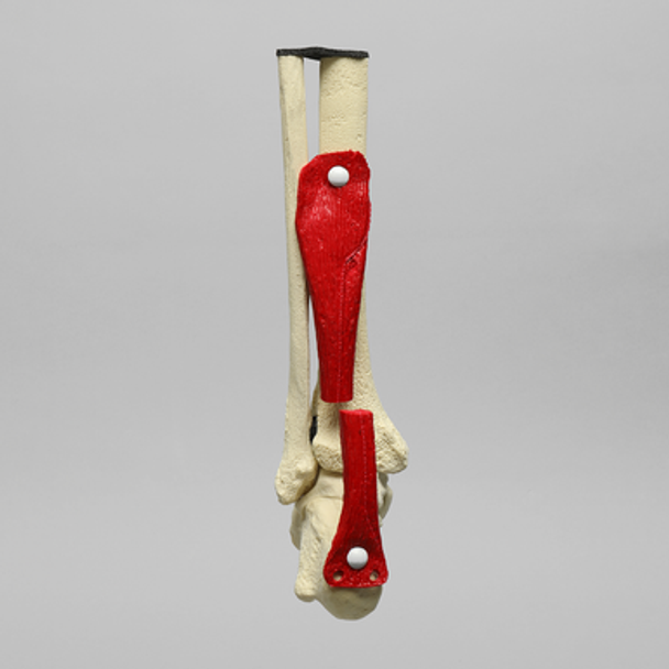 Ankle Joint with Ruptured Achilles
