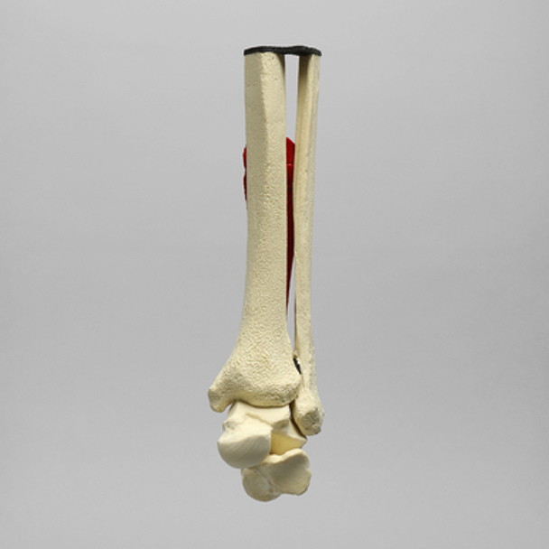 Ankle Joint with Ruptured Achilles