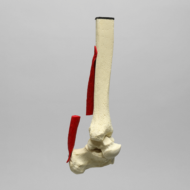 Ankle Joint with Ruptured Achilles
