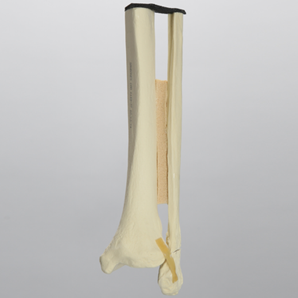 Ankle with Displaced Oblique Fracture