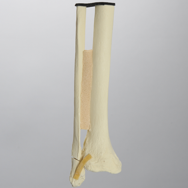 Ankle with Displaced Oblique Fracture
