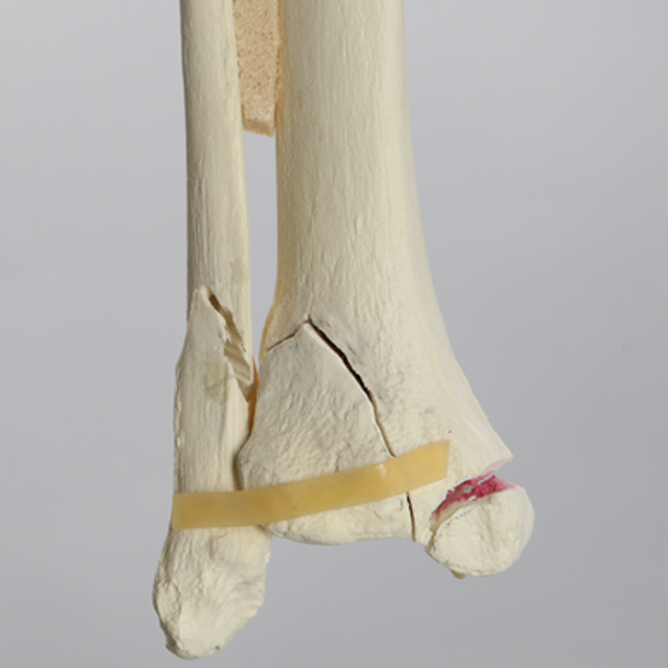 Ankle with Medial Malleolar and Oblique Fractures