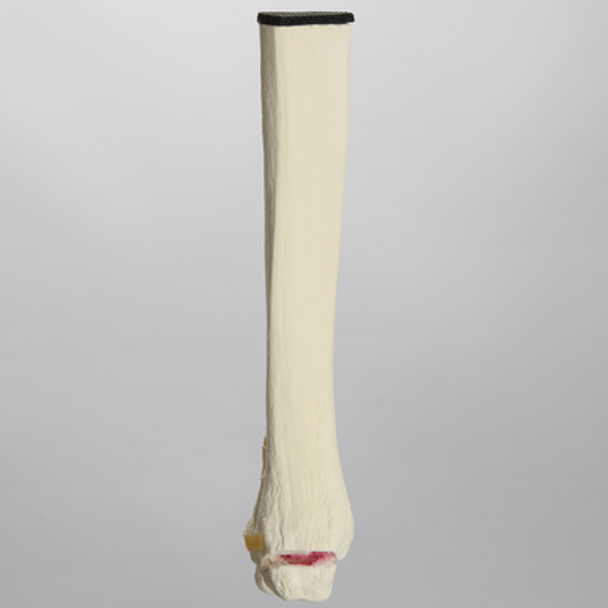 Ankle with Medial Malleolar and Oblique Fractures