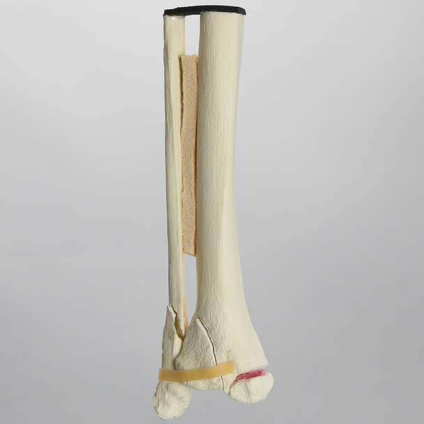 Ankle with Medial Malleolar and Oblique Fractures