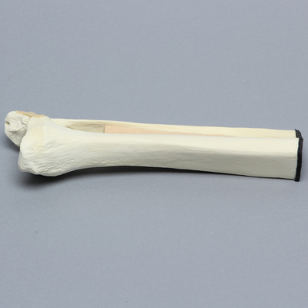 Ankle with Lateral Malleolar Fracture