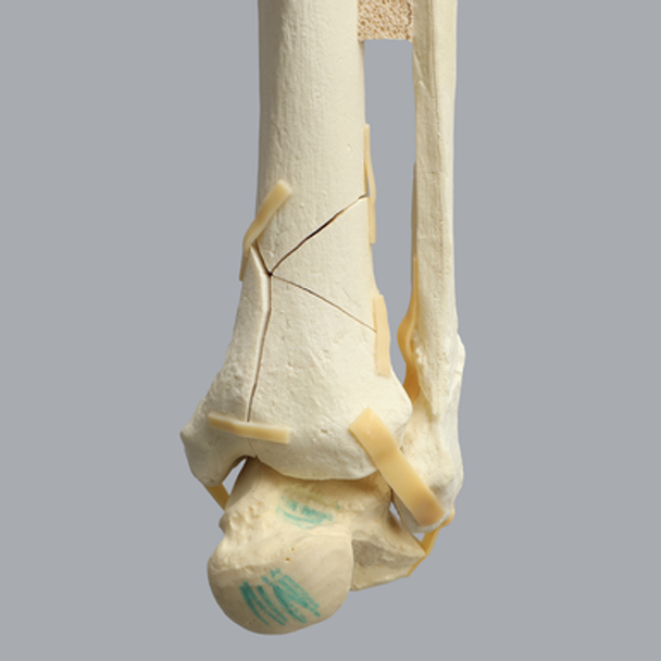Ankle with Pilon and Oblique Fractures