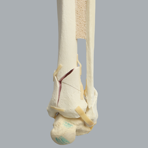 Ankle with Pilon and Oblique Fractures