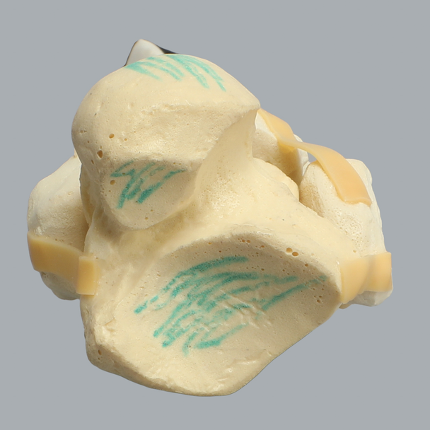 Ankle with Pilon and Oblique Fractures