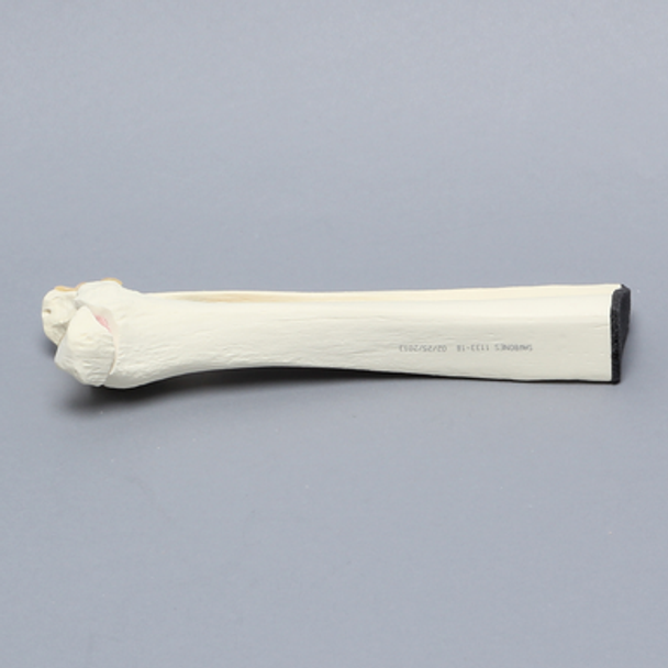 Ankle with Malleolar Fractures