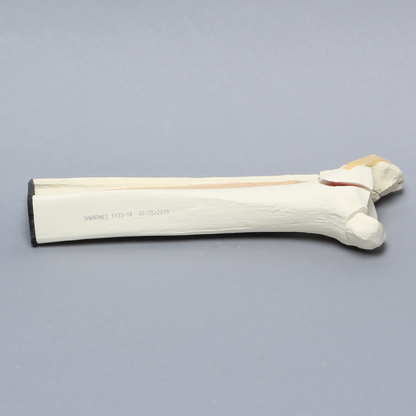 Ankle with Malleolar Fractures