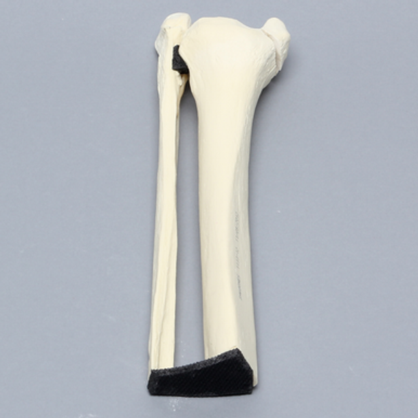 Ankle with Malleolar and Spiral Fractures