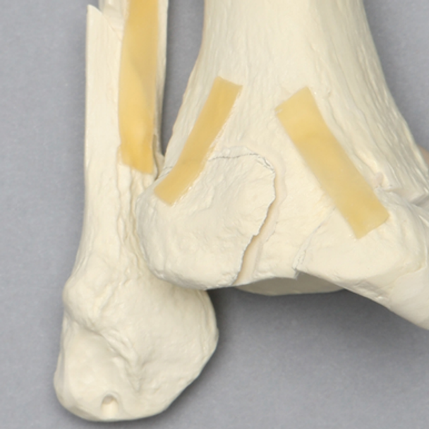 Ankle with Medial and Posterior Malleolar, and Oblique Fibular Fractures
