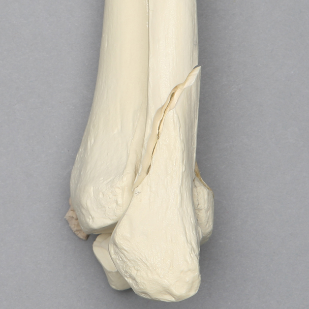 Ankle with Medial and Posterior Malleolar, and Oblique Fibular Fractures