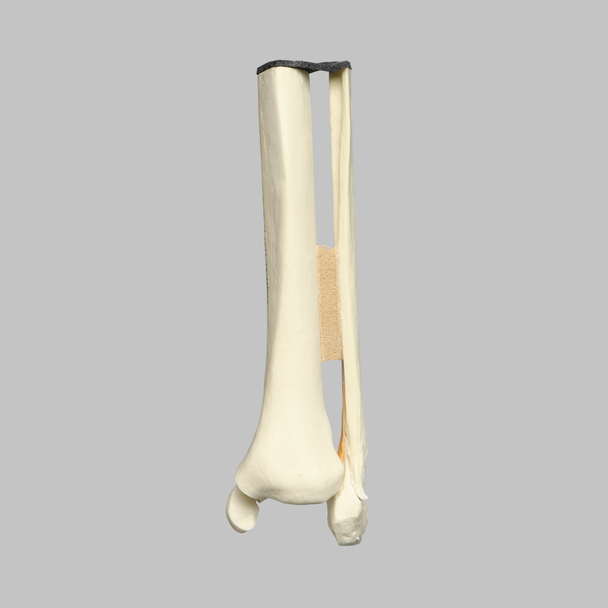 Ankle with Medial and Posterior Malleolar, and Oblique Fibular Fractures