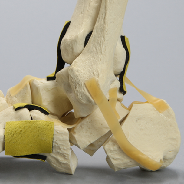 Foot and Ankle with Three-Part Calcaneal Fracture
