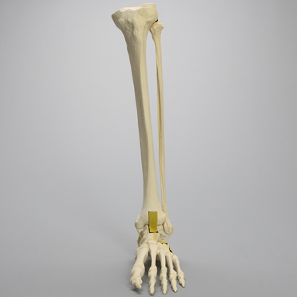 Foot and Ankle with Three-Part Calcaneal Fracture