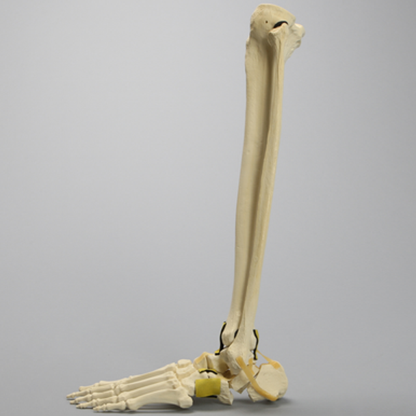 Foot and Ankle with Three-Part Calcaneal Fracture