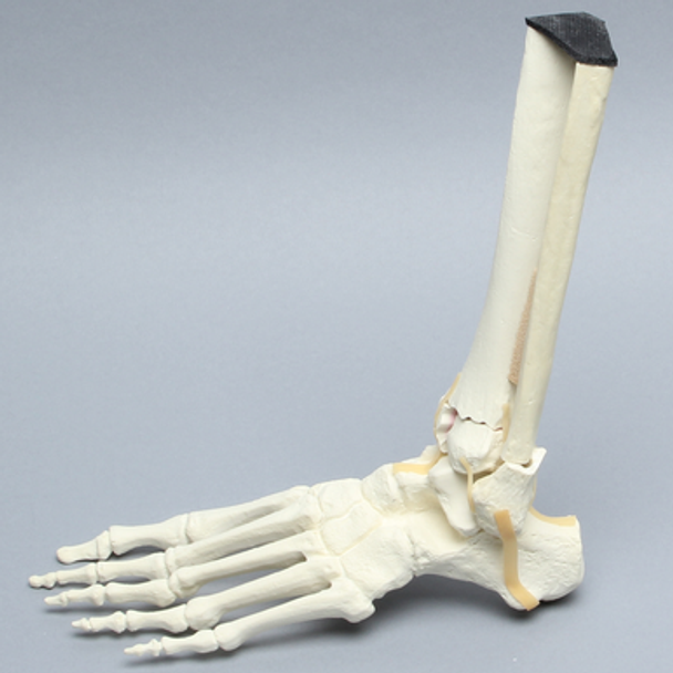 Foot and Ankle with Tibial Three-Part Pilon and Fibular Oblique Fractures