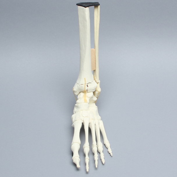 Foot and Ankle with Tibial Three-Part Pilon and Fibular Oblique Fractures