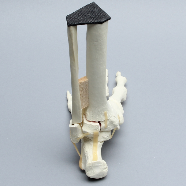 Foot and Ankle with Tibial Three-Part Pilon and Fibular Oblique Fractures