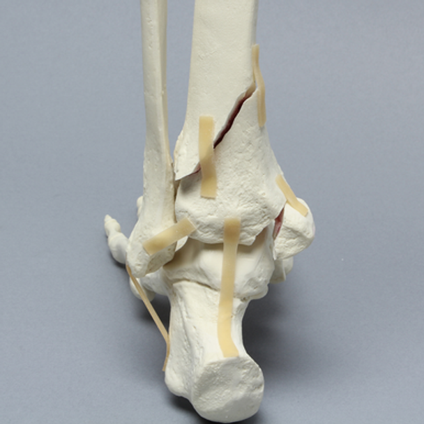 Foot and Ankle with Pilon Fracture